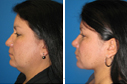 Before & After Photos